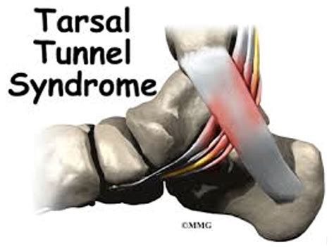 The most common known association is tarsal tunnel syndrome, which is tibial neuropathy as it crosses through the tarsal tunnel at the level of the ankle. . Tarsal tunnel syndrome reddit
